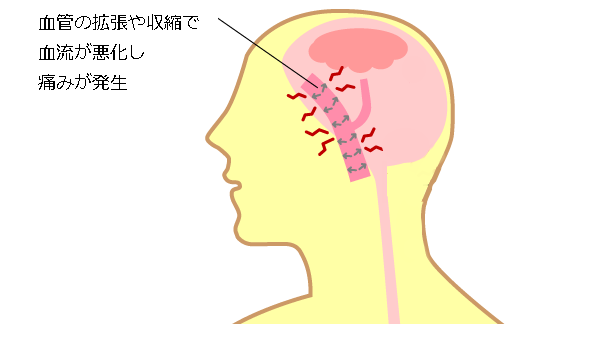 頭痛のメカニズム